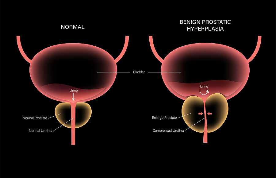 ipertrofia prostatica benigna pinerolo punto san lazzaro